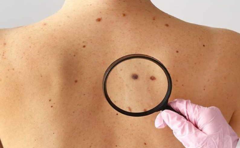 Predavanje za pacijente oboljele od melanoma